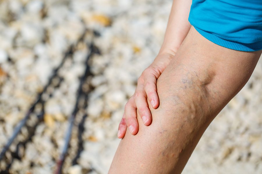 Elder Care in Winchester City VA: The Causes and Treatment for Varicose Veins.