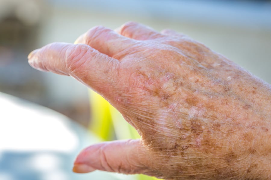 Home Health Care in Clark County VA: Elderly Eczema