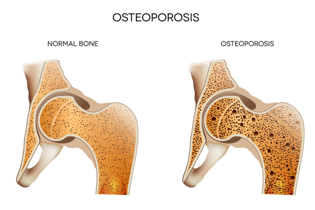Homecare in Arlington County VA: Preventing Osteoporosis